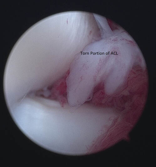 arthroscopic image of torn CCL ACL 